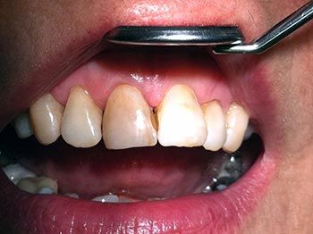 juurihoidon takia tummuneen hampaan valkaisu