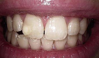 hampaiden kiillevaurion korvaaminen